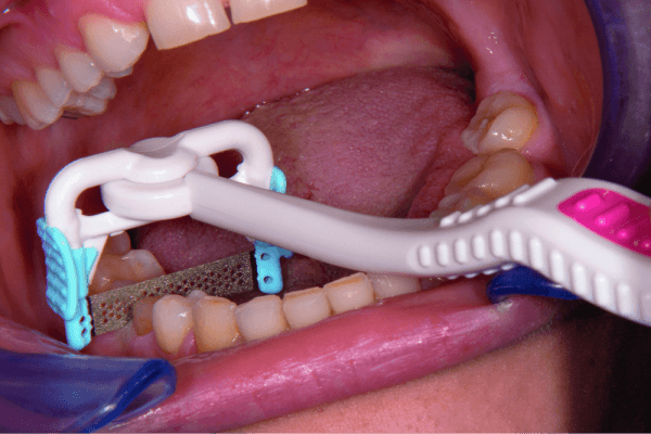 Image of NTI ProxyStrips