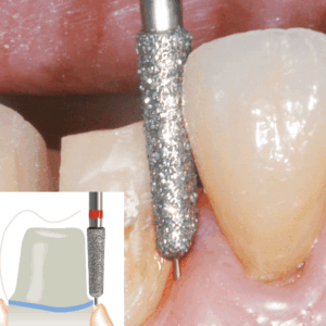 NTI Diamonds with Guide Pin for all-ceramic preparations